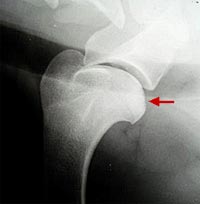 Osteochondrosis dissecans OCD )